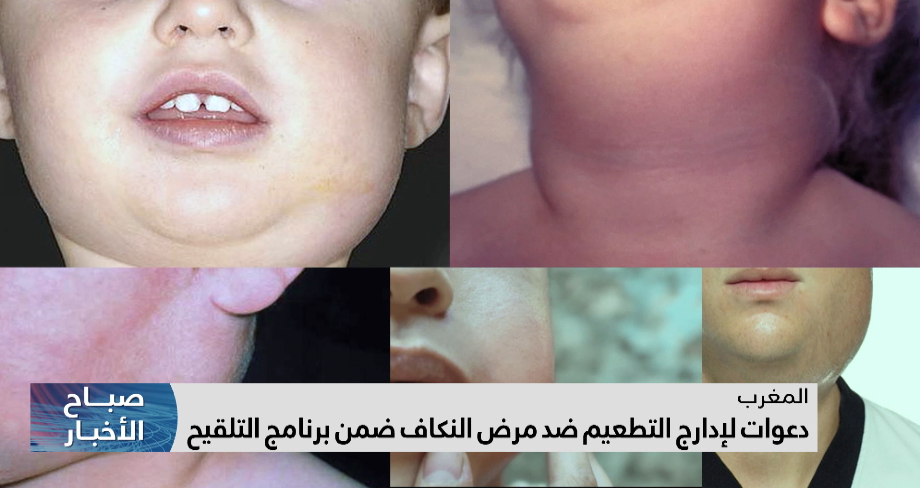دعوات لإدارج التطعيم ضد مرض النكاف ضمن برنامج التلقيح بالمغرب
