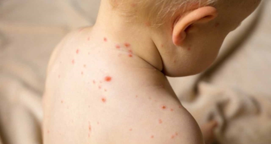 منظمة الصحة العالمية واليونيسف تحذران من تفشي مرض الحصبة بين الأطفال