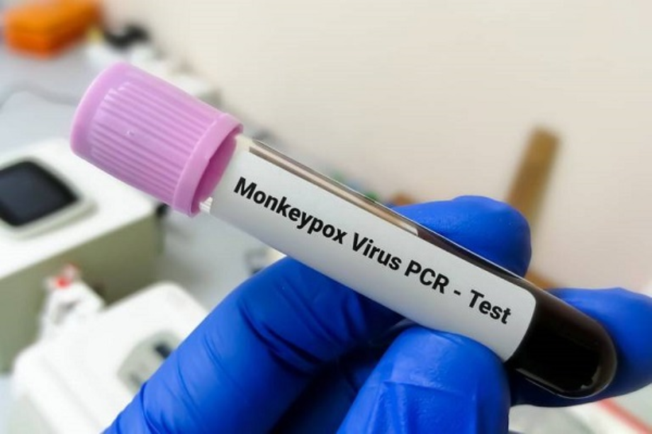 Bilan en France: variole du singe