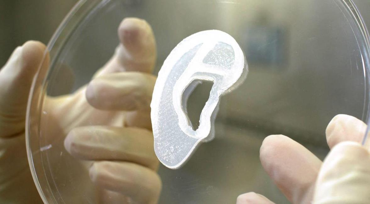 Greffe d'un implant d’oreille imprimé 3D